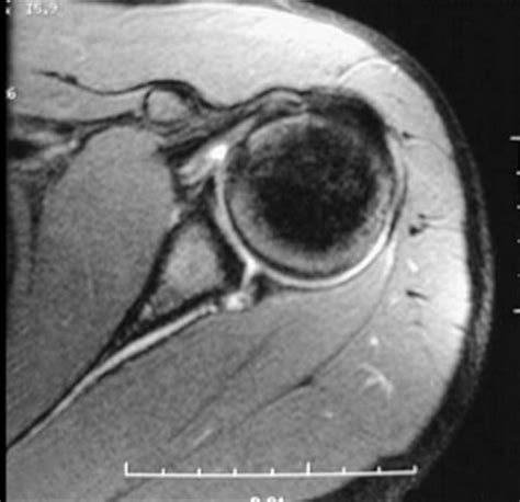 anterior posterior labral tear test|posterior labral tear shoulder mri.